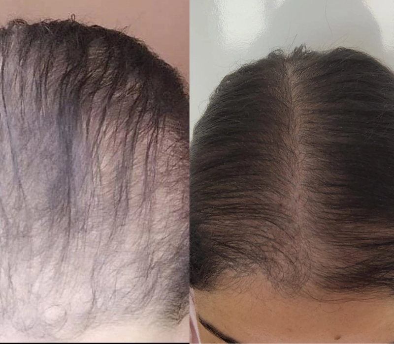 Clinica de tricologia - resultados -