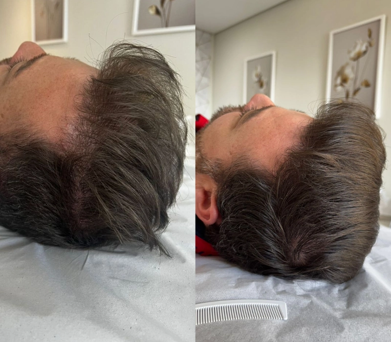 Clinica-de-tricologia-resultados