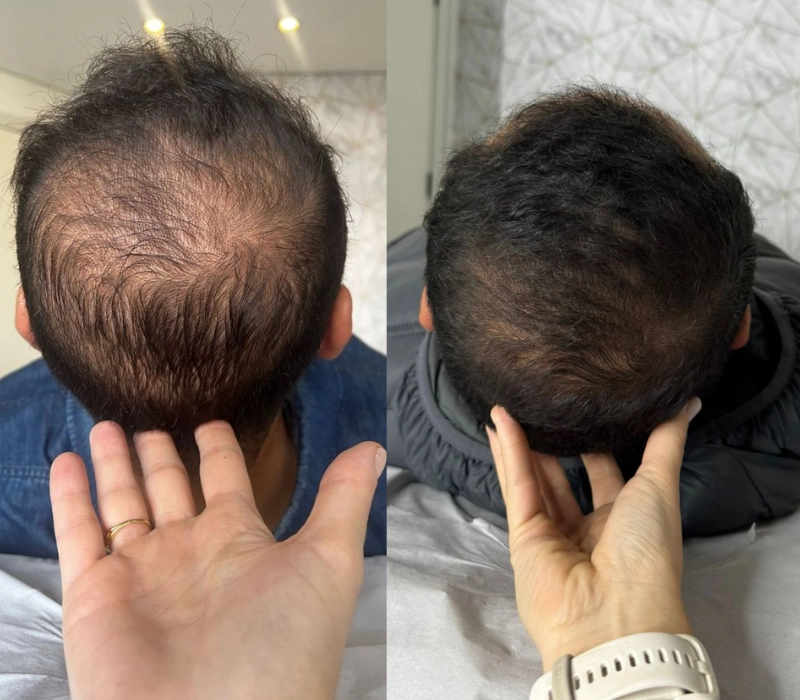 Clinica-de-tricologia-resultados